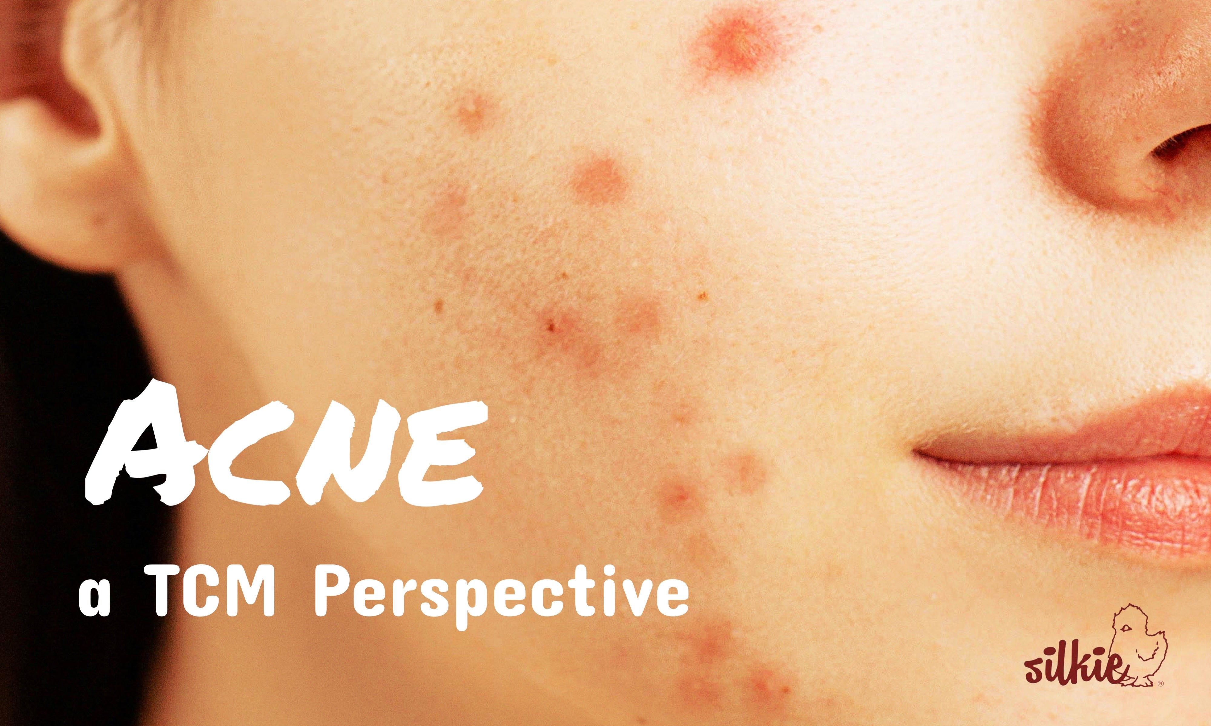 6 Types of Acne and What They Tell You About Your Skin