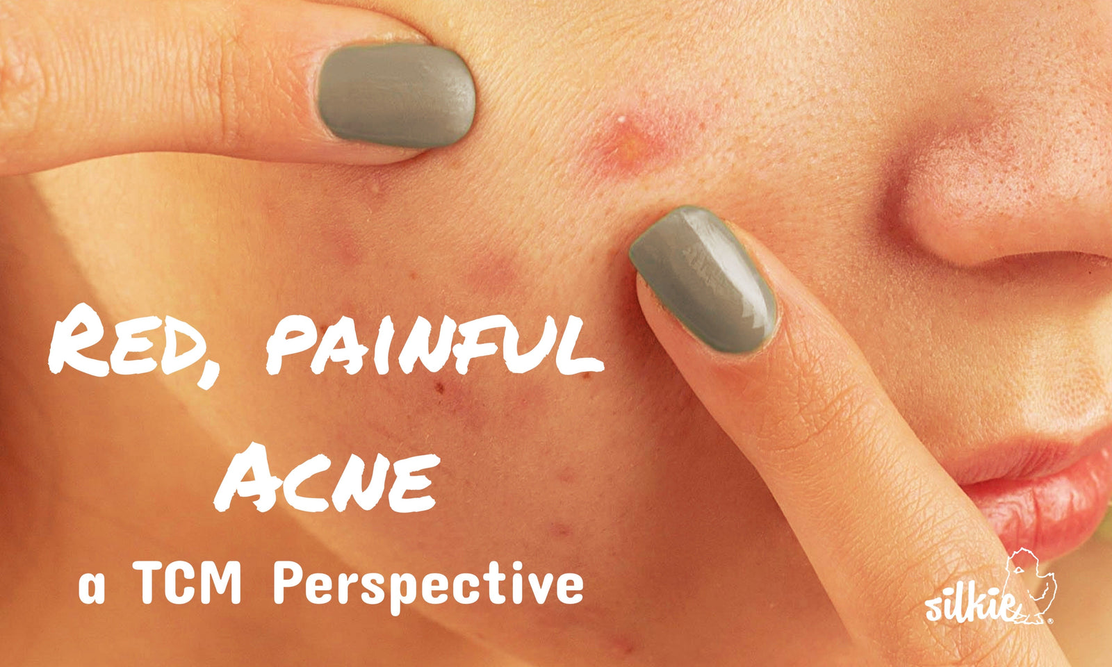 Understanding Inflammatory Breakouts: Why Acne Becomes Red, Painful, and Persistent