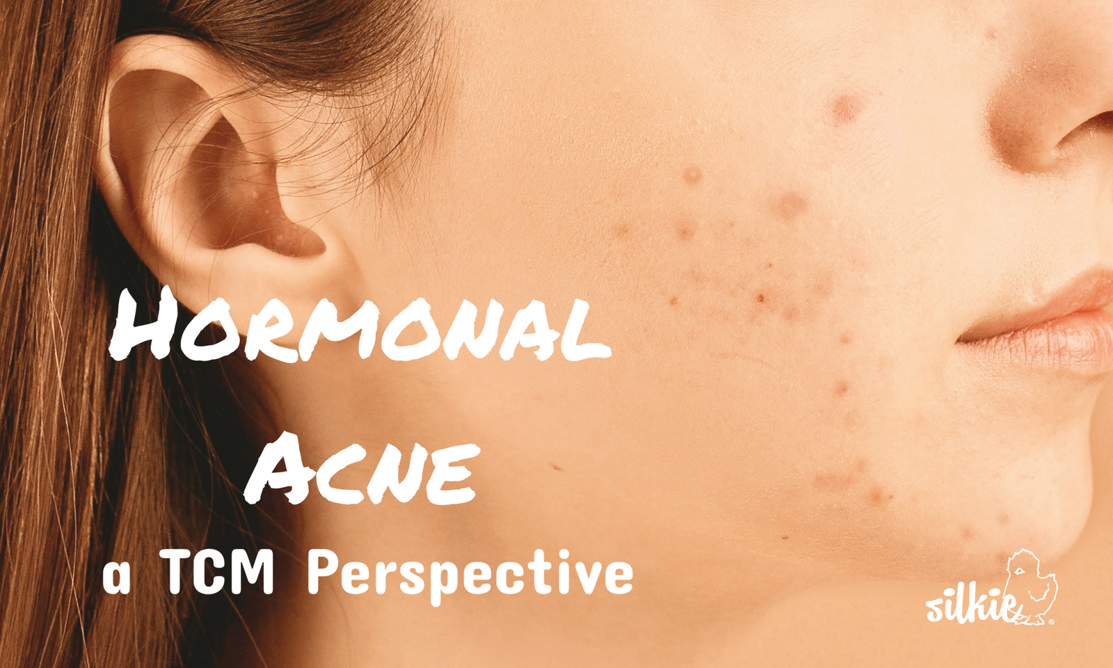 Why Hormonal Acne Keeps Coming Back (And What Your Skin Is Trying to Tell You)
